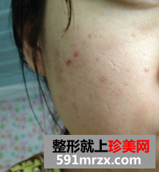 像素激光去痘坑 我的脸上光滑了