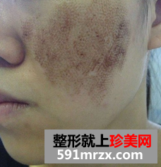 像素激光去痘坑 我的脸上光滑了