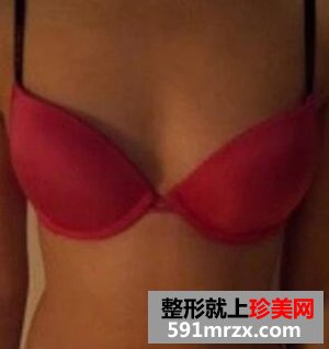 腋下切口娜高假体丰胸 终于可以穿低胸装