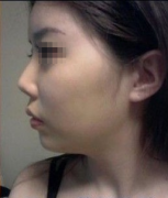 自体耳软骨隆鼻案例分享