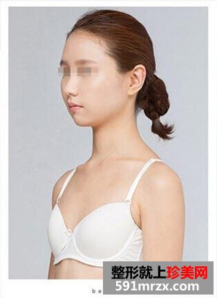 水滴假体隆胸 做一个敢于追求幸福的女人
