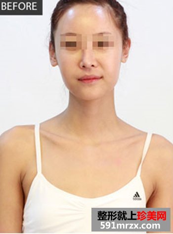 通过妙桃琴面假体隆胸 从A杯成功逆袭到C杯