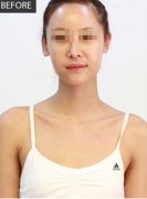 通过假体隆胸成功从A杯逆袭到C杯