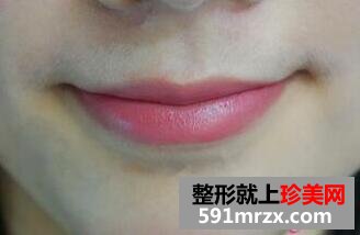 冰点脱唇毛 告别难看的小胡子