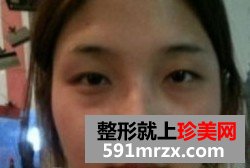 埋线双眼皮+激光治疗黑眼圈 像不像混血美女