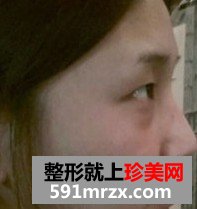 埋线双眼皮+激光治疗黑眼圈 像不像混血美女
