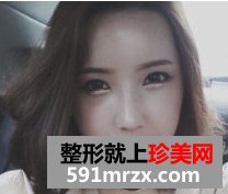 埋线双眼皮+激光治疗黑眼圈 像不像混血美女