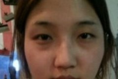 埋线双眼皮+激光治疗黑眼圈像不像混血美女？