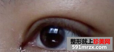 双眼皮+开眼角手术整形 拥有一双会说话的大眼睛