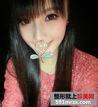 双眼皮+开眼角手术整形 拥有一双会说话的大眼睛