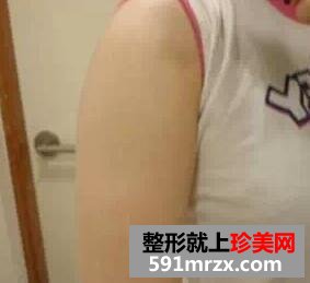 手臂吸脂减肥 终于有了纤纤玉臂