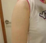 手臂吸脂减肥终于有了纤纤玉臂