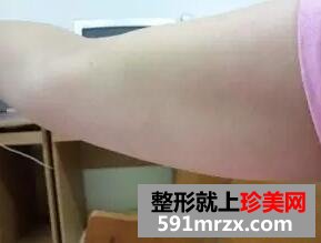 做了手臂吸脂减肥 手臂不再有下垂的肉肉