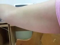 做了手臂吸脂减肥和下垂的肉肉说拜拜！