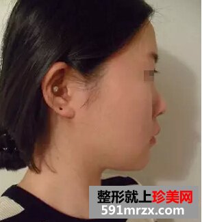 非手术隆鼻+鼻尖肥大整形 御姐范十足