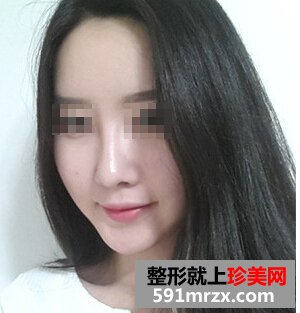 非手术隆鼻+鼻尖肥大整形 御姐范十足