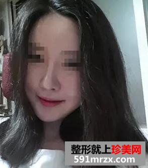做了隆鼻和鼻尖整形 感觉鼻子很漂亮