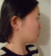 非手术隆鼻+鼻尖肥大整形突然就变美了