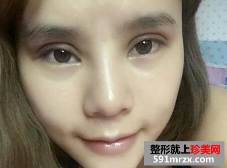 做了生物焊接双眼皮 他们都说我像洋娃娃
