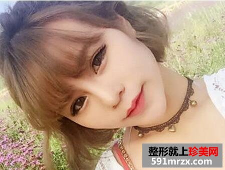 做了生物焊接双眼皮 他们都说我像洋娃娃