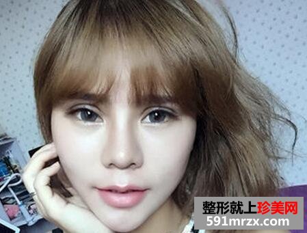 做了生物焊接双眼皮 他们都说我像洋娃娃
