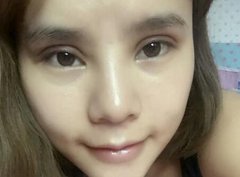 生物焊接双眼皮经历分享