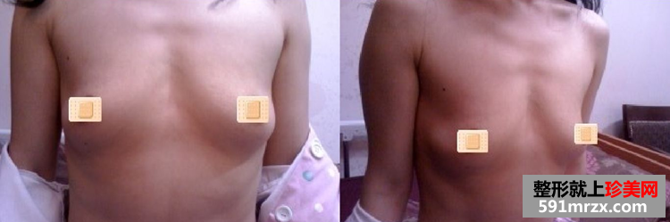 假体丰胸手术恢复全过程 看37岁的妈妈如何逆袭成少女