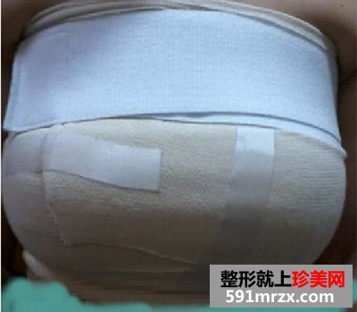 假体丰胸手术恢复全过程 看37岁的妈妈如何逆袭成少女