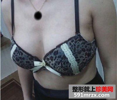 假体丰胸手术恢复全过程 看37岁的妈妈如何逆袭成少女