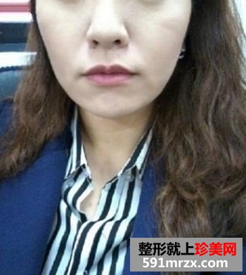 做了像素射频除皱 一下年轻了很多