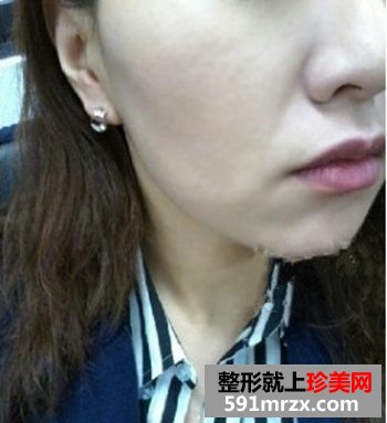 做了像素射频除皱 一下年轻了很多