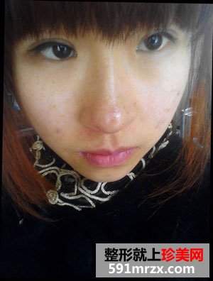 做了激光祛咖啡斑 终于不用再羡慕别人了
