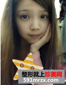 韩式纳米仿真隆鼻术+韩式无痕开眼角 大家说我像混血儿