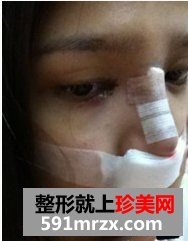 韩式纳米仿真隆鼻术+韩式无痕开眼角 大家说我像混血儿