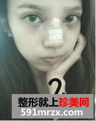 韩式纳米仿真隆鼻术+韩式无痕开眼角 大家说我像混血儿