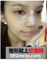 韩式纳米仿真隆鼻术+韩式无痕开眼角 大家说我像混血儿