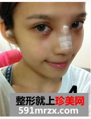 韩式纳米仿真隆鼻术+韩式无痕开眼角 大家说我像混血儿