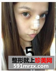 韩式纳米仿真隆鼻术+韩式无痕开眼角 大家说我像混血儿