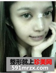 韩式纳米仿真隆鼻术+韩式无痕开眼角 大家说我像混血儿