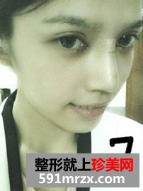 韩式纳米仿真隆鼻术+韩式无痕开眼角 大家说我像混血儿