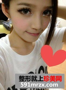 韩式纳米仿真隆鼻术+韩式无痕开眼角 大家说我像混血儿