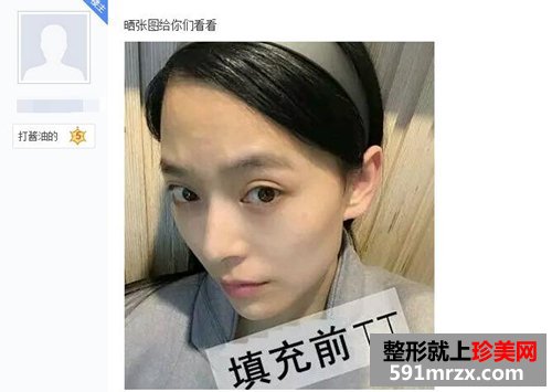 做了脸部自体脂肪填充 现在照相非常上镜