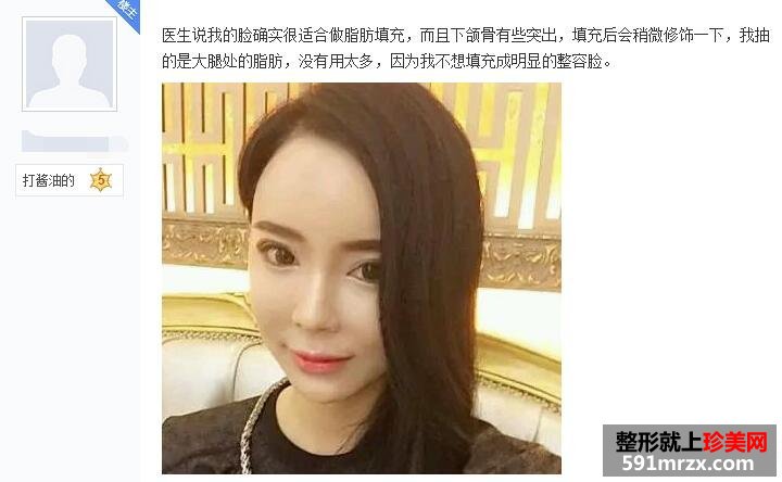 做了脸部自体脂肪填充 现在照相非常上镜