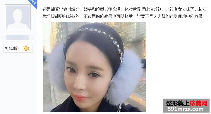 做了脸部自体脂肪填充 现在照相非常上镜