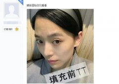 做了脸部自体脂肪填充现在照相很好看