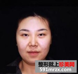 面部吸脂减肥 朋友不再叫我胖子脸