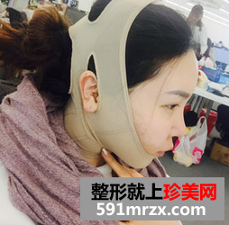 面部吸脂减肥 朋友不再叫我胖子脸