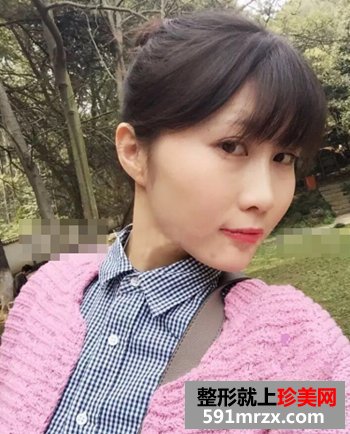 膨体垫下巴一年了 没有任何副作用哦