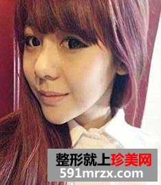 看我的垫下巴手术+玻尿酸隆鼻前后对比 简直就是两个人