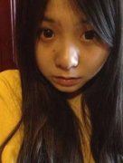 垫下巴手术+玻尿酸隆鼻前后效果对比